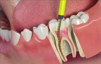 Painless Root Canal Treatment